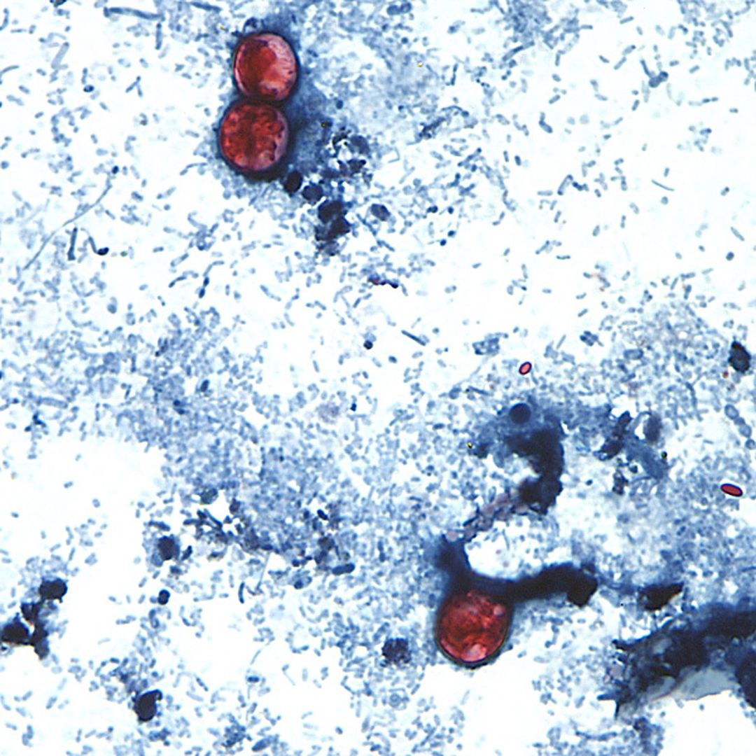 Mueren 2 Personas con Ciclosporiasis en EUA: Detectan Factores que Complican la Enfermedad